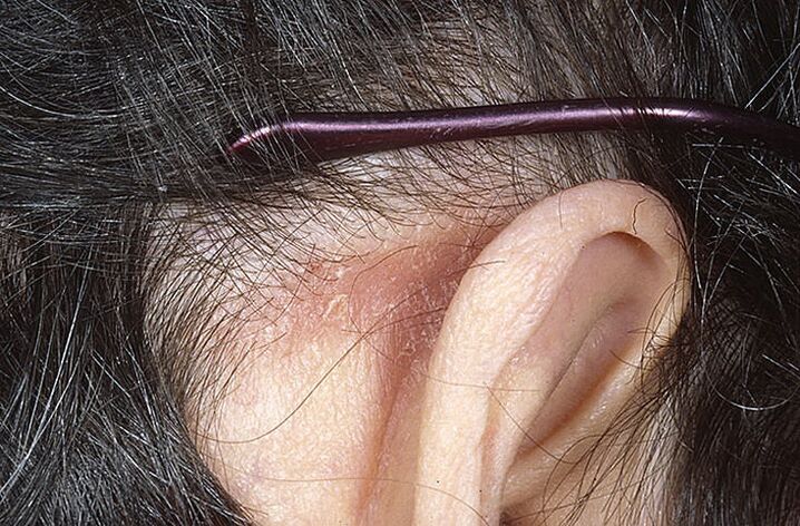 Psorijatični plak iza uha