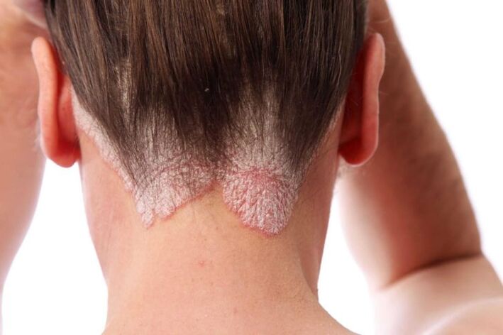 psorijaza