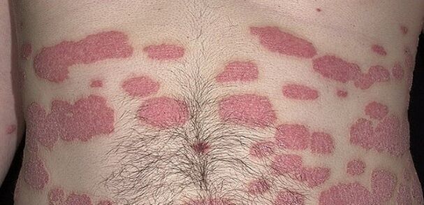 Psorijaza