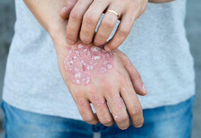 Mesniched psorijaza