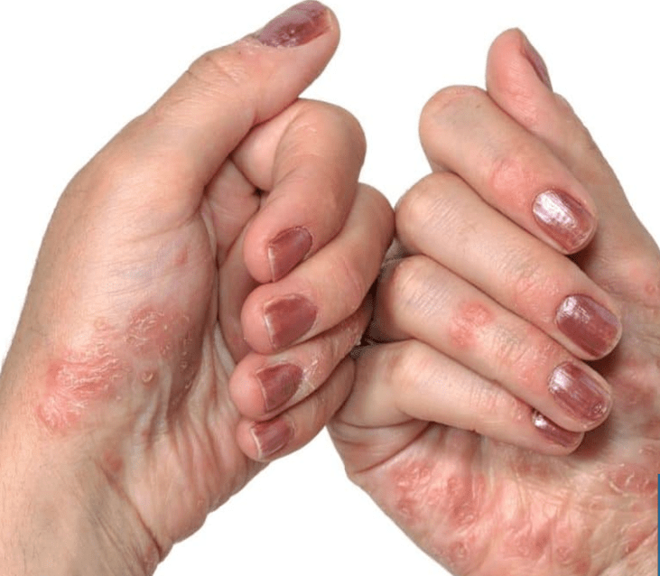 Psorijaza u rukama