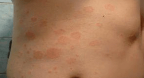 Nesretna psorijaza