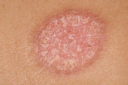 psorijaza
