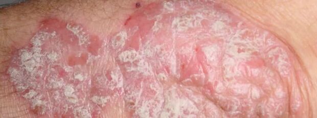 Mesniched psorijaza