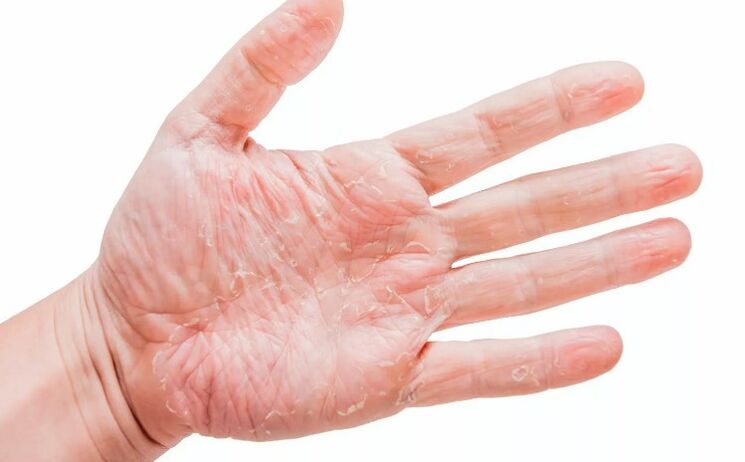 Psorijaza