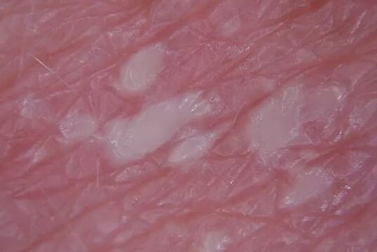 Pustulenia psorijaza