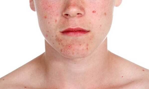 Simptomi psorijaze