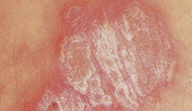 psorijaza