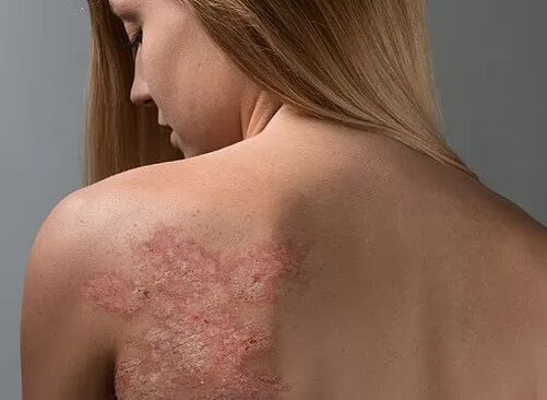 Psorijaza na leđima djevojke