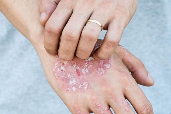 karakteristični simptomi psorijaze na rukama