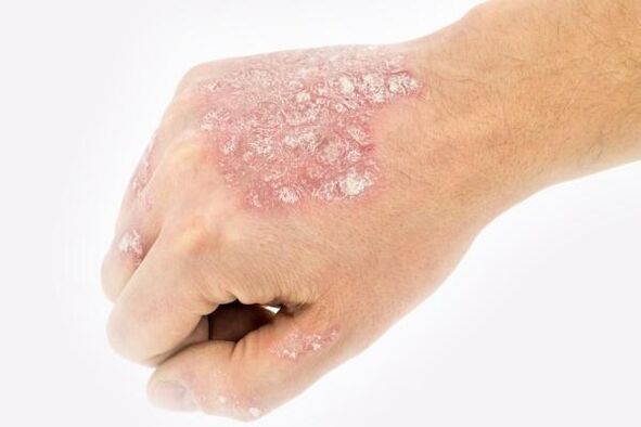 mehanizam razvoja psorijaze na rukama