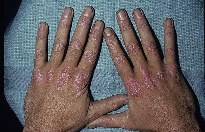 razlozi za razvoj psorijaze na rukama