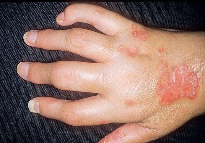 psorijatični artritis na rukama