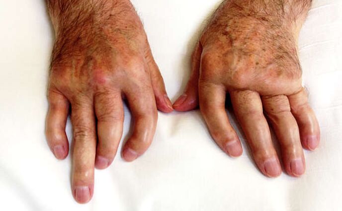 Mutilativni artritis kod psorijaze