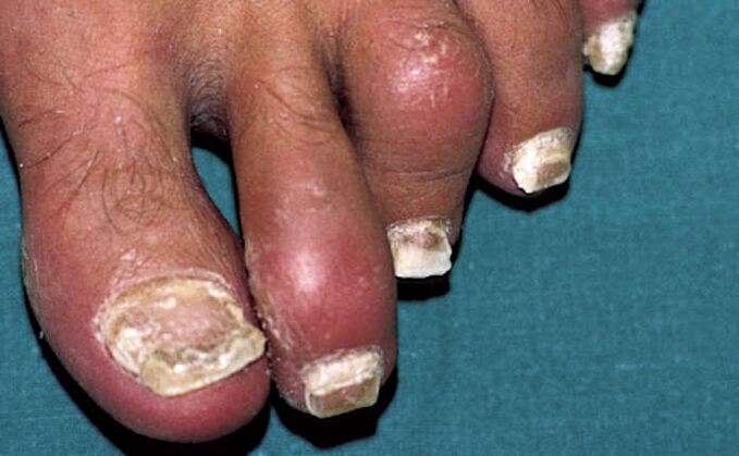 Psorijaza s zahvaćenošću noktiju i upalom zglobova (artritis) nožnih prstiju