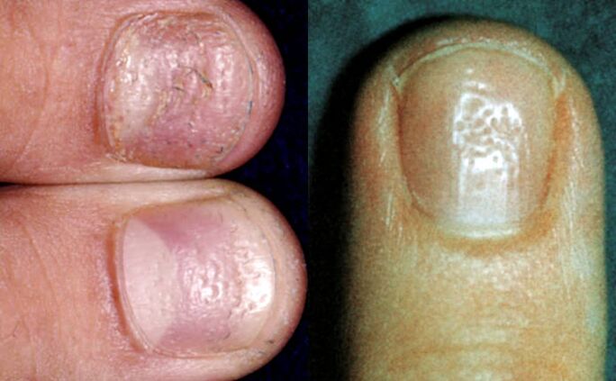 Simptom naprstka - višestruka udubljenja na površini ploče nokta