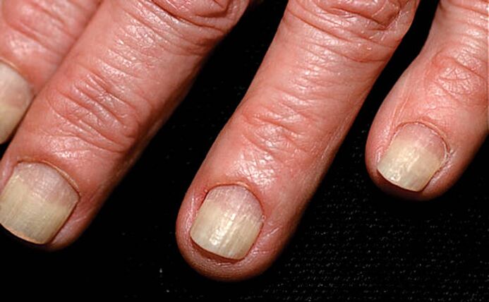 Širenje oniholize s ruba nokta na nabor nokta