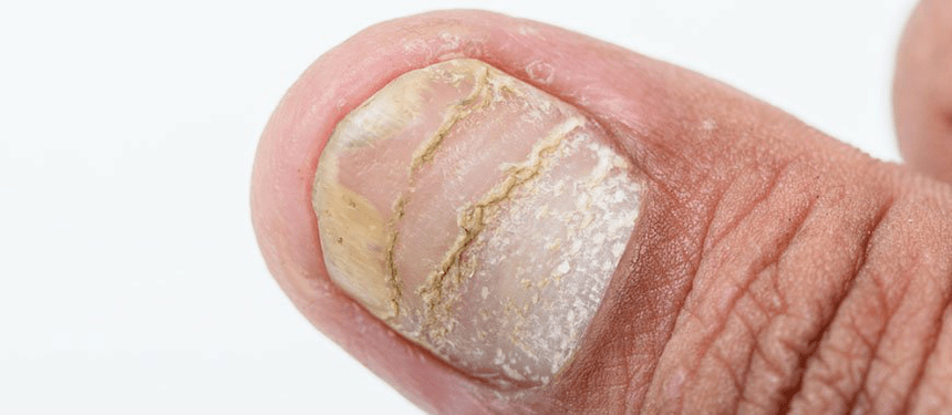 akutni oblik komplikacija psorijaze na noktu